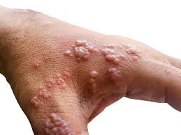 What is this new Monkeypox virus? Everything you need to know.